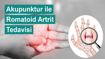Akupunktur ile Romatoid Artrit Tedavisi